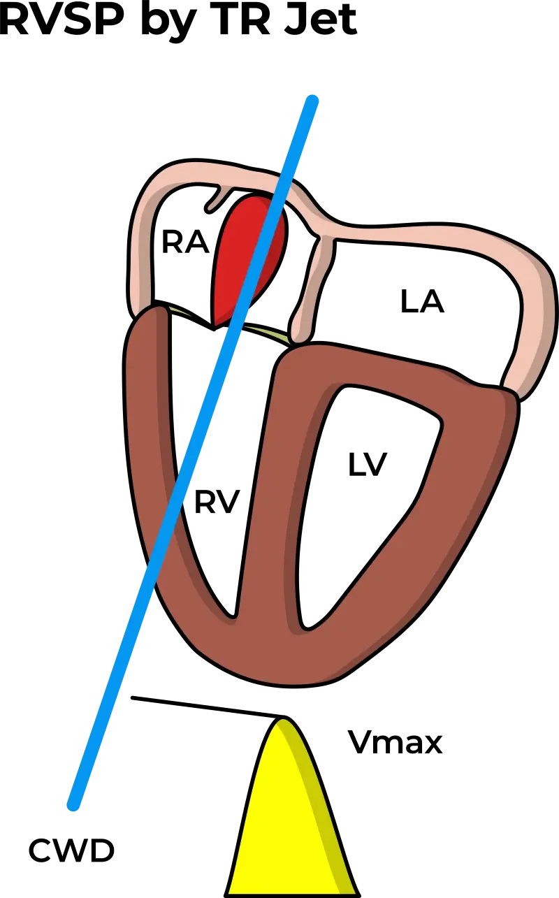 Pulmonary Artery Systolic Pressure